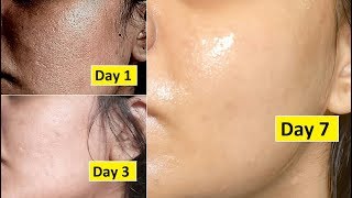 Skin Repair  Close Large OPEN PORES in 1 week Remove Dark Spots Anti Aging [upl. by Dhaf]