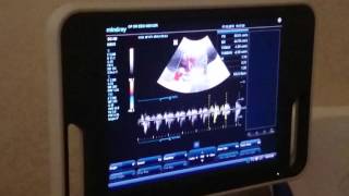 Gebelikte 20 haftalık bebeğin ultrason görüntüsü  20 week ultrasound in pregnancy [upl. by Tigdirb]