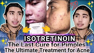 ISOTRETINOIN THE ULTIMATE TREATMENT FOR ACNE  Legit And Effective Ways to Get Rid of Pimples Fast [upl. by Alael]