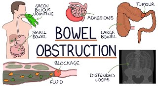 Understanding Bowel Obstruction [upl. by Rexanna852]