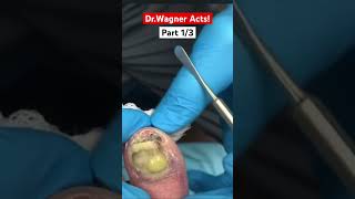 DRAINAGE OF HUGE ABSCESS🤯Part 13shorts [upl. by Nylrats]