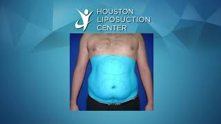 Liposuction for Men  Liposuction Before amp After [upl. by Nwahsit]