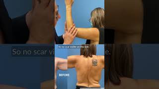 How to place an arm lift scar shorts brachioplasty scarreveal [upl. by Rombert]