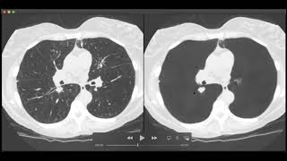 Jared Christensen MD ClearRead CT Explanation [upl. by Enattirb]