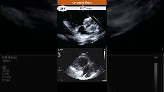 Coronary Sinus View in Echo [upl. by Eladnyl]