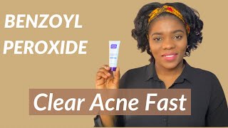 Clear Acne With Benzoyl Peroxide Pros and Cons [upl. by Ycnuahc]