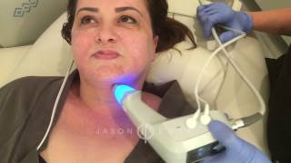 BTL Exilis Ultra  Neck Lift Skin Tightening  Cellulite Reduction  Beverly Hills [upl. by Taber]