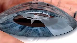 Watch live surgery using the laser cataract system  how does it work Eye News TV [upl. by Laersi]