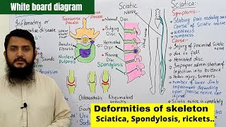 Deformities of skeleton part 02  Disc Slip  Spondylosis  Sciatica  Arthritis [upl. by Toll]