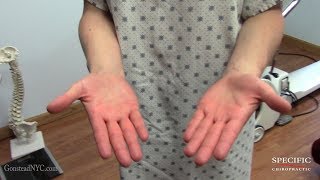 Raynauds disease phenomenon HELPED Dr Suh Gonstead Chiropractor [upl. by Skylar]