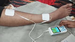 deep peroneal nerve stimulation EMS placement of electrode active and inactive full guidance [upl. by Ario]