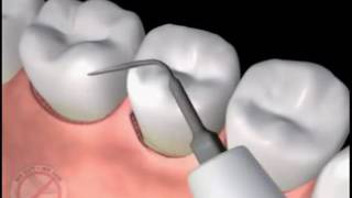 Tratament Parodontoza Laser [upl. by Casimire]