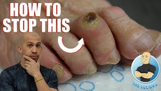 FOOT CORN REMOVAL FULL TREATMENT  FOOT HEALTH MONTH 2018 3 [upl. by Lala]