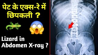 Lizard in Abdomen Xray  पेट के एक्सरे में छिपकली  Artifact  UdayXray [upl. by Aromas185]