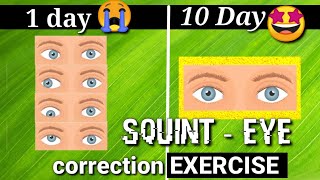 Squint Eye treatment NATURALLY with exercises at Home [upl. by Marty419]