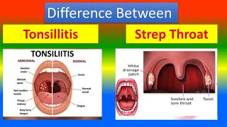 Difference between Tonsillitis and Strep Throat [upl. by Lazar332]