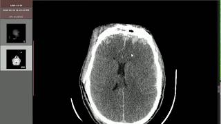 Post traumatic SAH SDH brain edema pneumocephalus [upl. by Odnomyar]