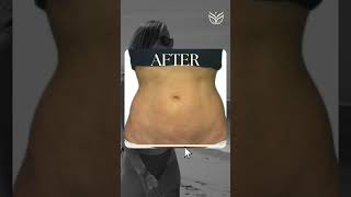 Get Summer Ready with Sculpsure and Botox botox beach beachbody [upl. by Olly]