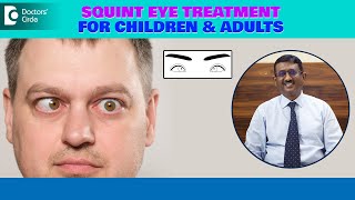 Best Treatment for SquintCrossed Eye How can I fix SQUINT EyeDrSriram RamalingamDoctors Circle [upl. by Oirad]