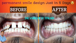 Teeth Gap  Dont worry Teeth gap close in 5 Days Zirconia crowns Emax crowns Midline diaestma [upl. by Baerman]