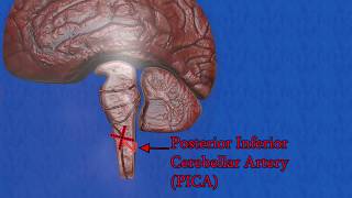 Wallenberg syndrome  Lateral medullary syndrome  posterior inferior cerebellar artery syndrome [upl. by Starinsky]