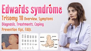 Edwards syndrome trisomy 18 causes symptoms diagnosis treatment screening prevention FAQ [upl. by Fortier517]