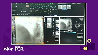 Imageguided PCI of distal left main disease  AICTAsiaPCR 2024 [upl. by Aicile]