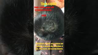 Tinea capitis kerion awarenesshaircarefungalinfectionsdrvaraprasadtineaalopecia childhood [upl. by Llorrad]