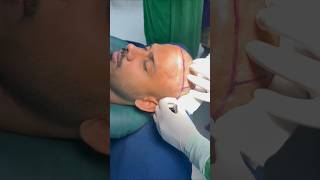 Hair Transplant Live Bangladesh  hairtransplantbangladesh [upl. by Assylla]