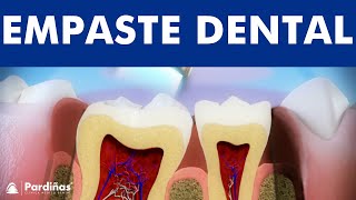 El empaste o restauración con composite  Tratamiento caries © [upl. by Nomae]