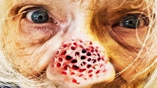 Worlds Worst Trypophobia What is Trypophobia Cysts Acne Makeup Pimples Documentary Censored [upl. by Eartnoed866]