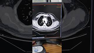 What Is A Pulmonary Angiographyradiologytechnologist radiological ctscan angiography mr [upl. by Natfa915]