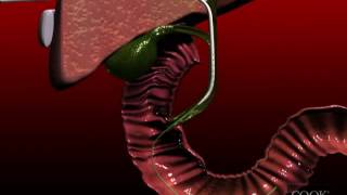 Biliary Drainage Catheter insertion animation [upl. by Ladonna]