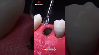 Tooth Extraction procedure of broken tooth dentistry dental dentist doctor bds mds [upl. by Zzahc]