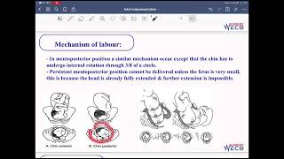 Obstetrics Fetal malpresentation 2 [upl. by Otiv387]