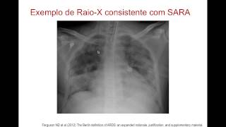 A nova definição de SARA e a fisiopatologia [upl. by Yelrac]