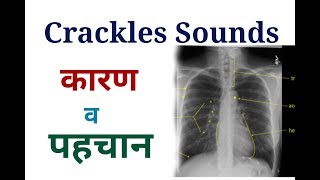 Crackles Sounds and it Causes in Various disease  causes of wheezing [upl. by Kciredes]