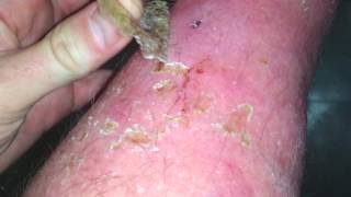 peeling scab  Sunburn [upl. by Bellda]