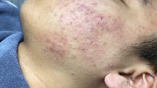 ACNE TREATMENT VU QUYNH MI Acne On Teens Cheek 2024 [upl. by Doris751]