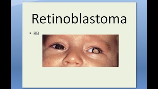 Pathology 509 a Retinoblastoma Eye Tumor Retina Child Flexner WinterSteiner Home Wright Rosette [upl. by Kowalski249]