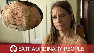 Skin Condition Leaves Woman with Nearly 6000 Tumors [upl. by Ardnohsed525]