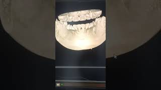 CBCT 3rd amp4rd quadrant Dental scan [upl. by Dlawso]