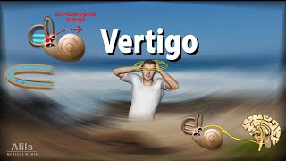 Vertigo Causes Pathophysiology and Treatments Animation [upl. by Gibbs]