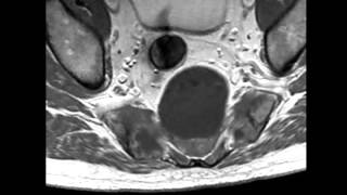 Sacral Chordoma [upl. by Adniroc]