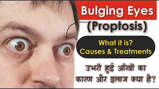 What is Bulging Eyes Proptosis Causes amp Treatments  उभरी हुई आंखों का असल कारण क्या है [upl. by Aihsatan]