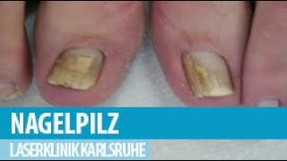 Nagelpilz Onychomykose mit dem Laser behandeln [upl. by Holtz]