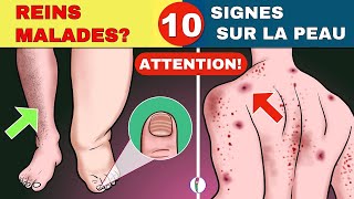 10 SIGNES DUNE MALADIE DES REINS [upl. by Burnie]