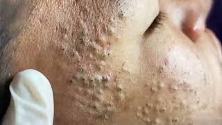 Big Cystic Acne Blackheads Extraction Blackheads amp Milia Whiteheads Removal Pimple Popping 033 [upl. by Gretna505]