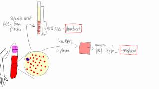 Anemia Basic lab tests  hematocrit hemoglobin reticulocyte MCV morphology [upl. by Andrei]