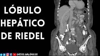 Lóbulo Hepático de Riedel ⚡️ imagenes por TAC y RM [upl. by Jessey]